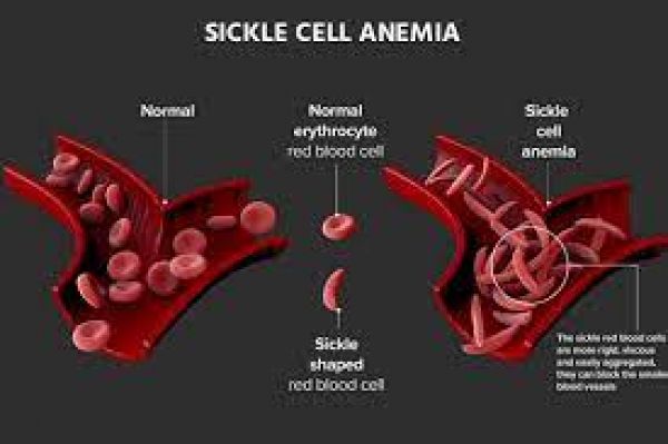 A possible cure for sickle cell?