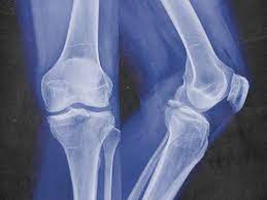 Physical activity linked to lower risk of fracture