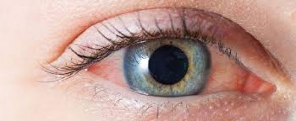 कंजंक्टिवाइटिस में सावधानी रखने से बचाव संभव