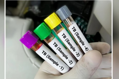  भारत में पिछले दशक में तपेदिक के मामलों में 21% की कमी: डब्ल्यूएचओ रिपोर्ट