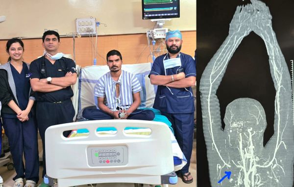 रायपुर : मेकाहारा के डाॅक्टराें ने चाकू से कटी मुख्य धमनी व सबक्लेवियन आर्टरी को जोड़कर बचाया युवक का हाथ